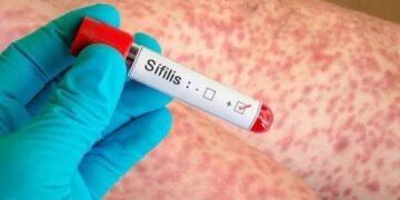 Los casos de sífilis crecieron 38,5% en tres años y alcanzaron un récord en el país